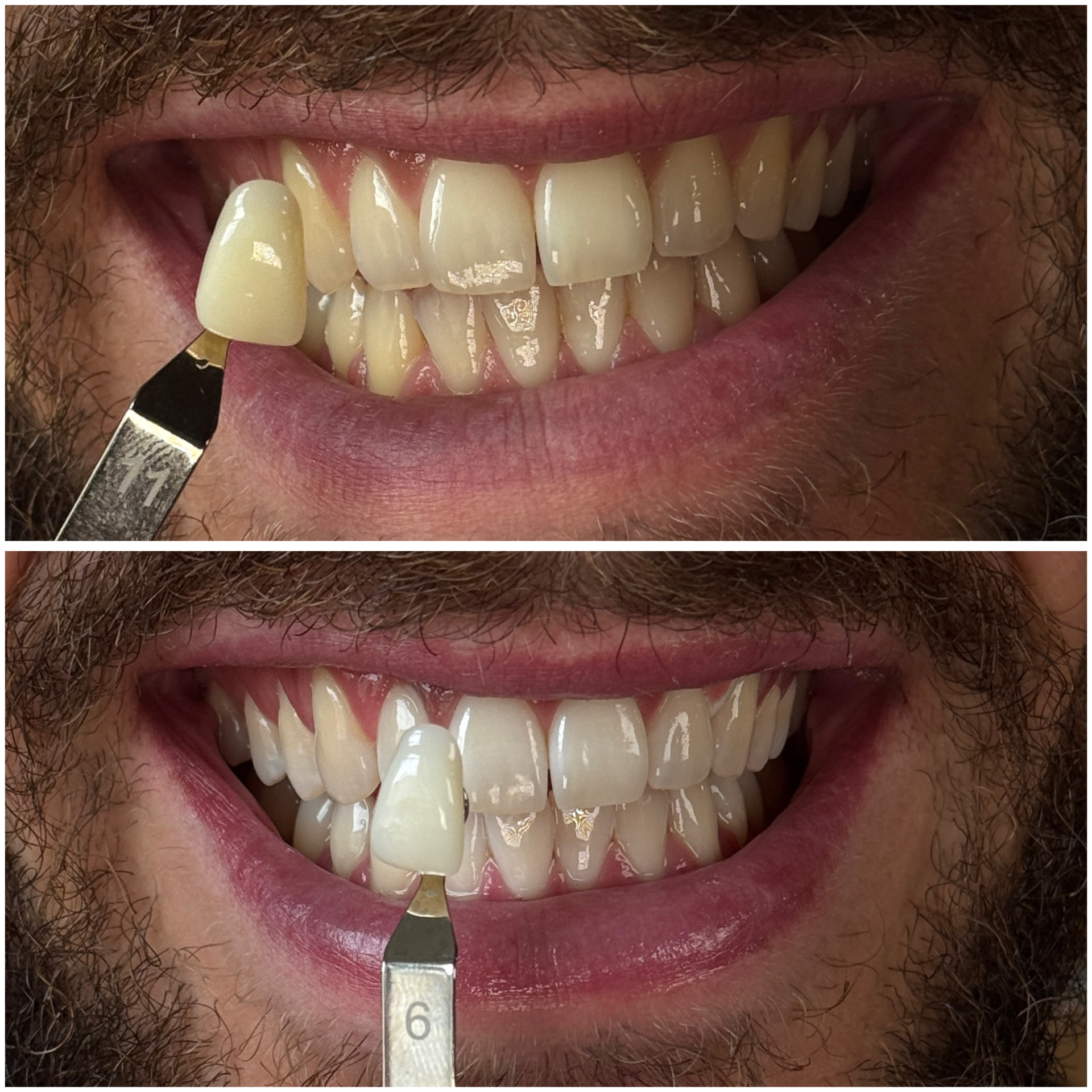 Before and after cosmetic teeth whitening, shade 11 to shade 6