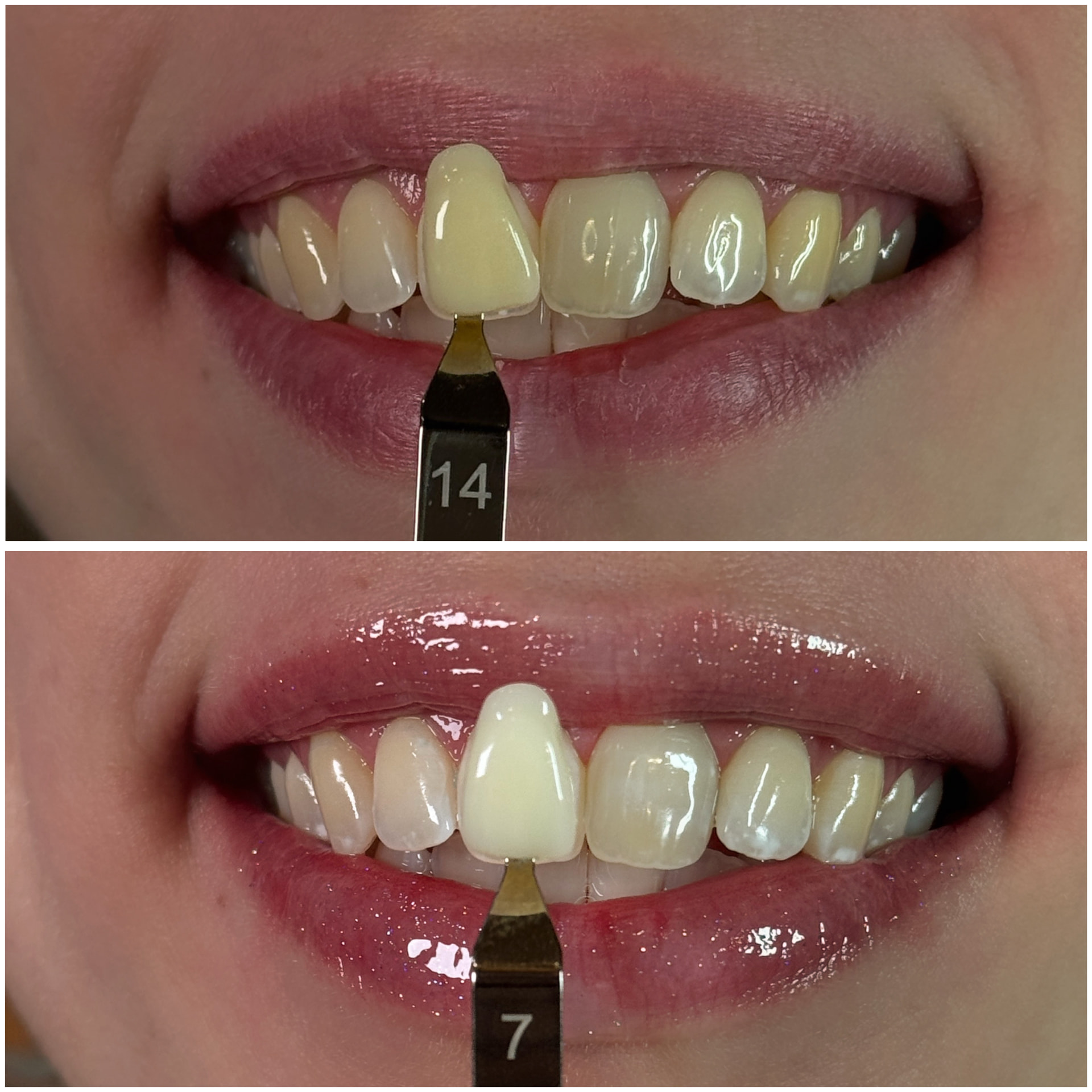 Before and after cosmetic teeth whitening, shade 14 to shade 7