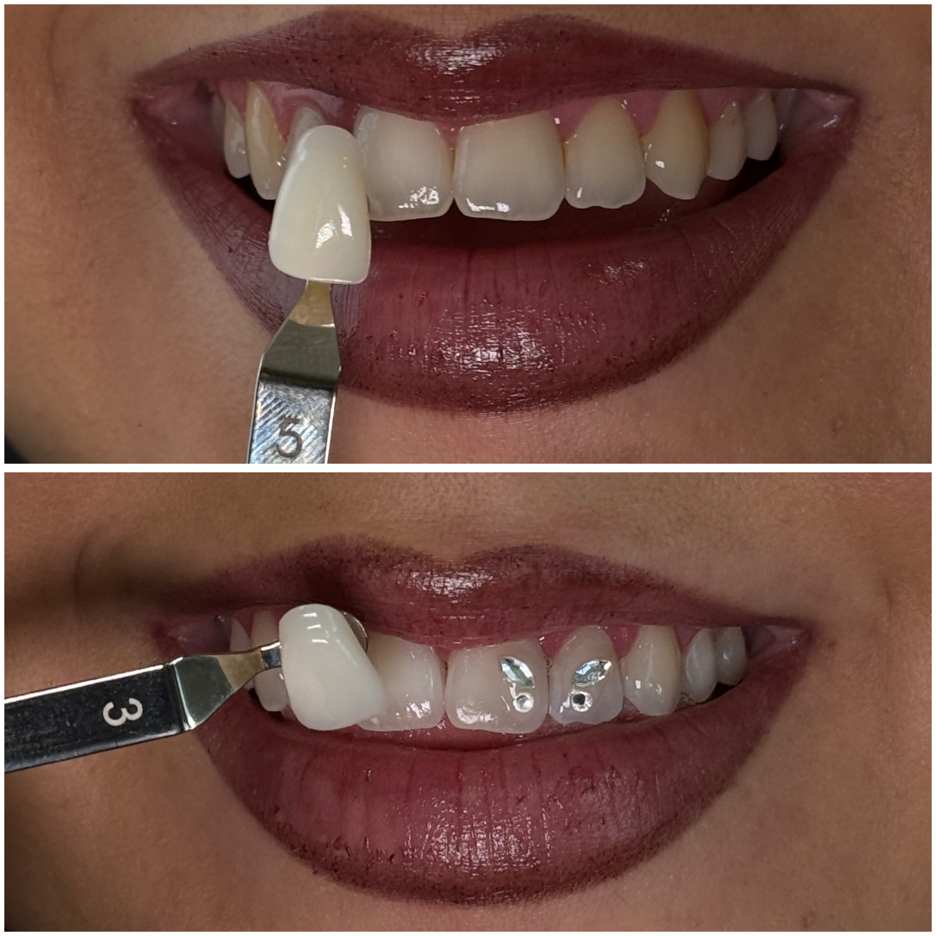 Before and after cosmetic teeth whitening, shade 5 to shade 3