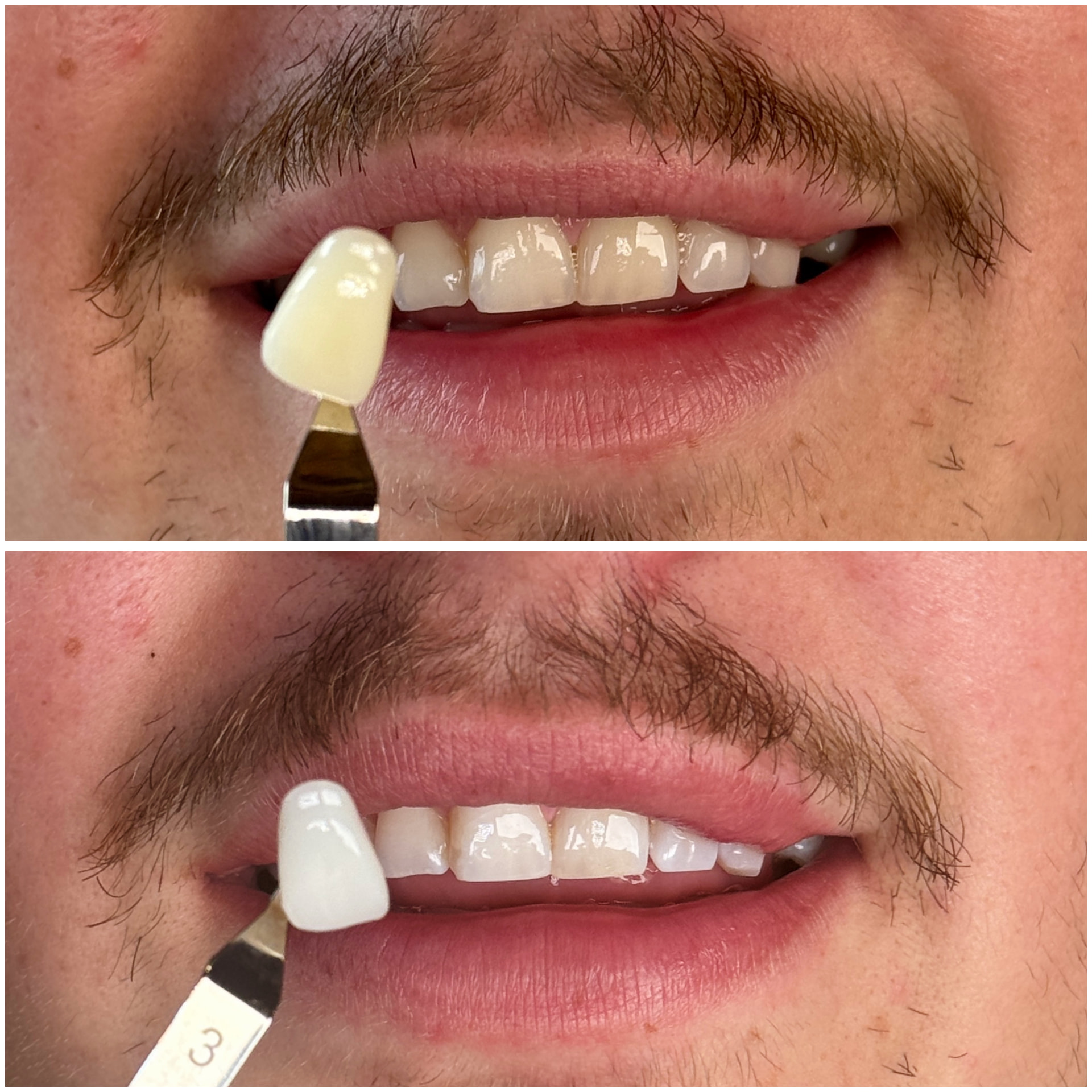 Before and after cosmetic teeth whitening, shade comparison