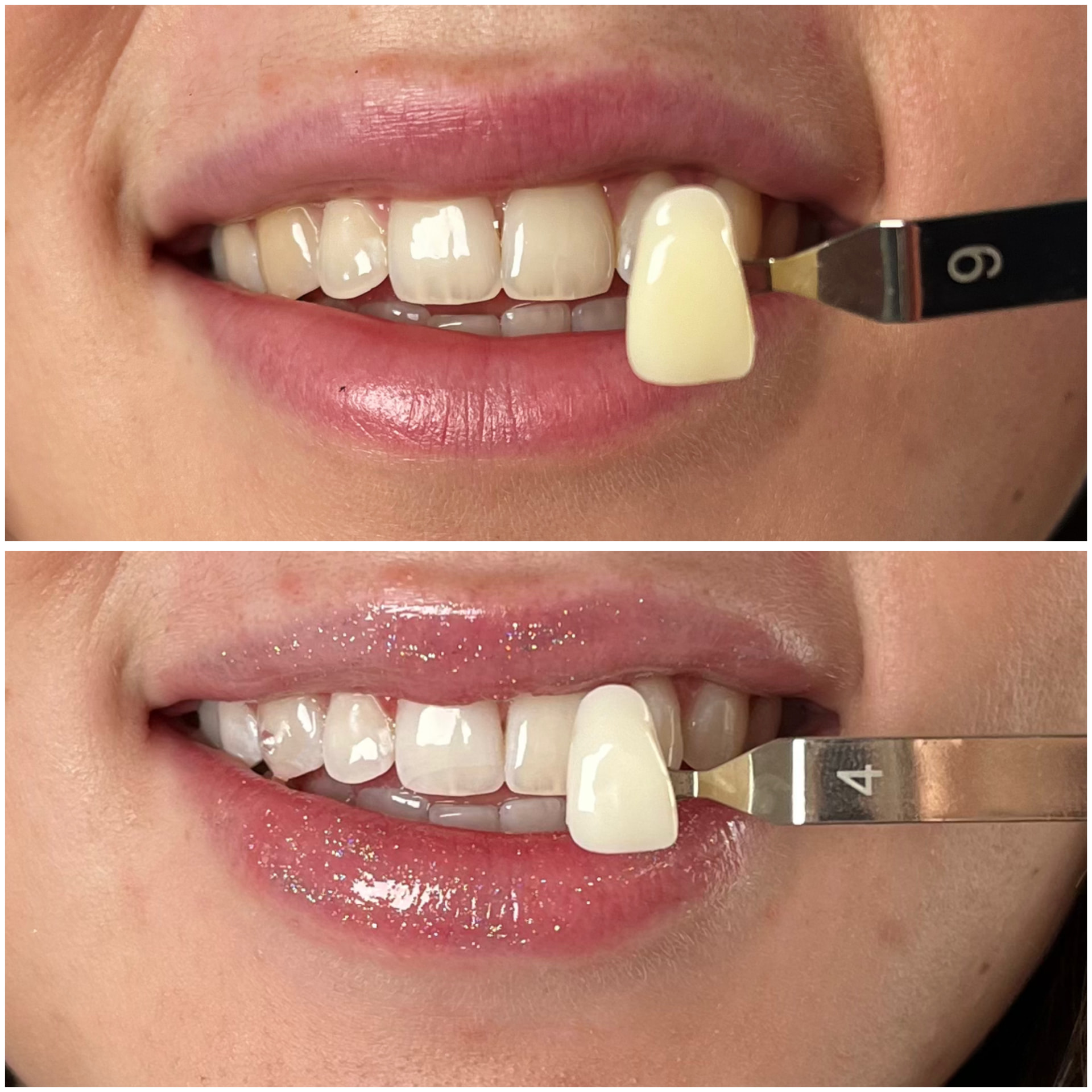 Before and after cosmetic teeth whitening, shade 9 to shade 4