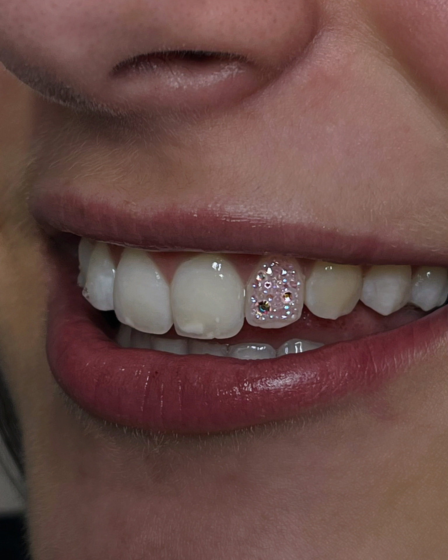 Tooth fully covered in small pink and clear crystals
