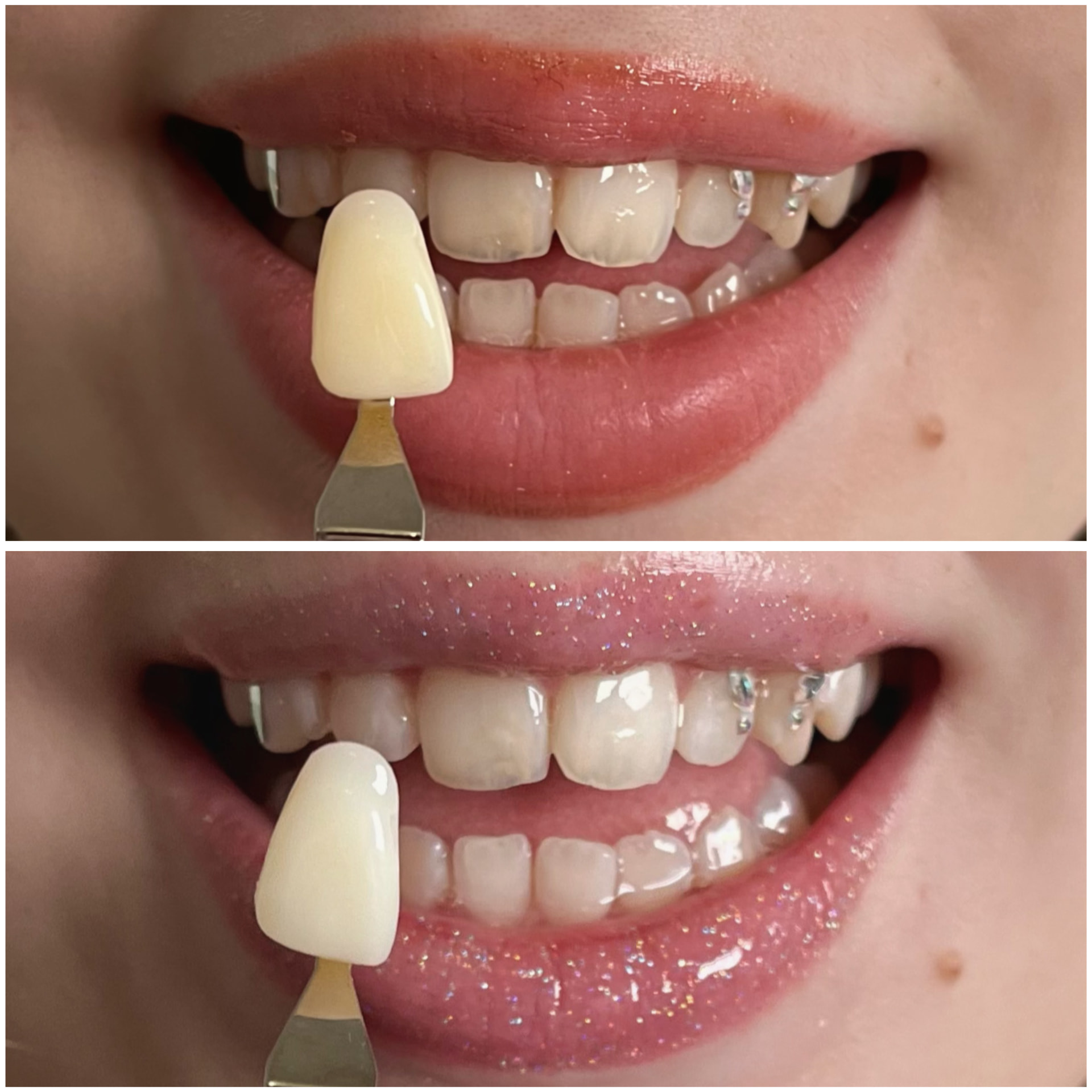 Before and after cosmetic teeth whitening on a client with tooth gems